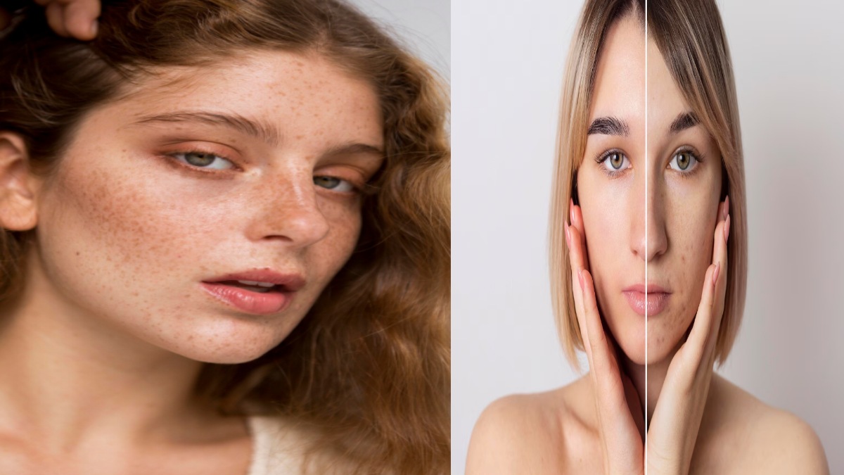 Hyperpigmentation: Causes, Types, Prevention, and Effective Treatment Options for Clearer Skin