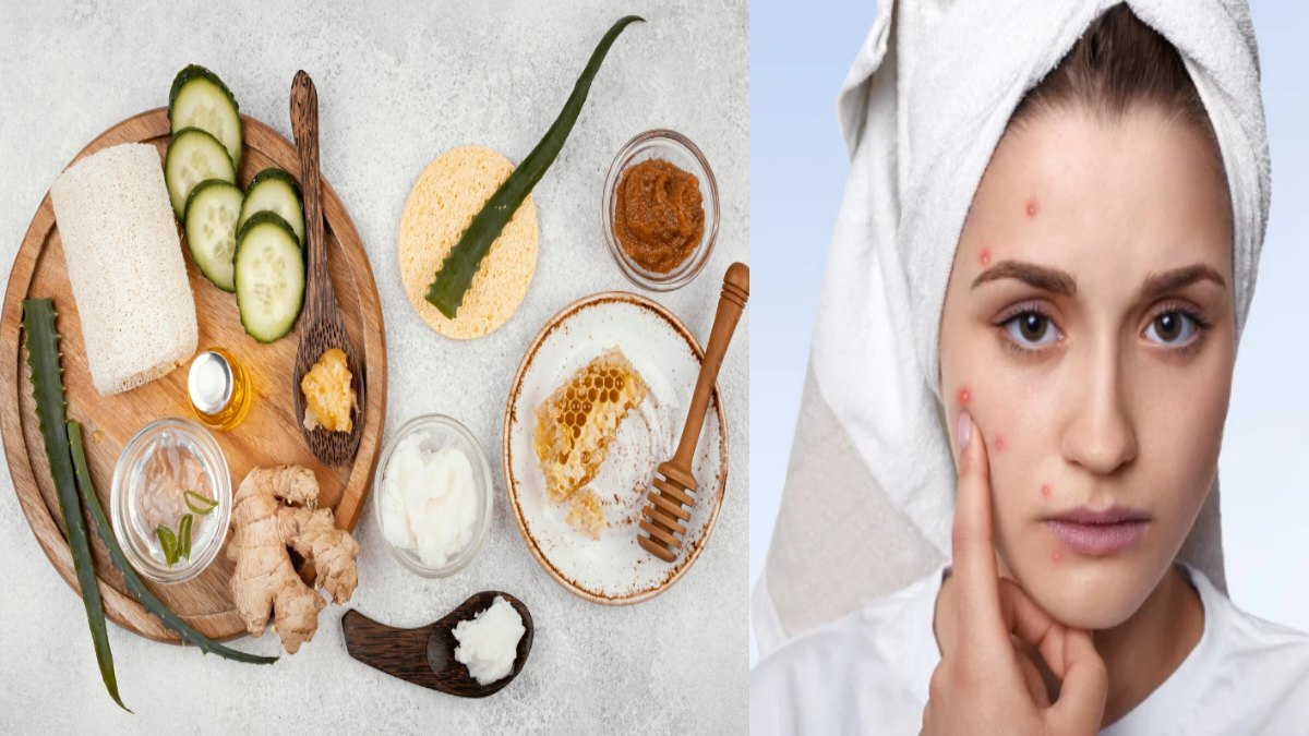 Best Home Remedies for Acne: Simple Ways to Support Clearer, Healthier Skin