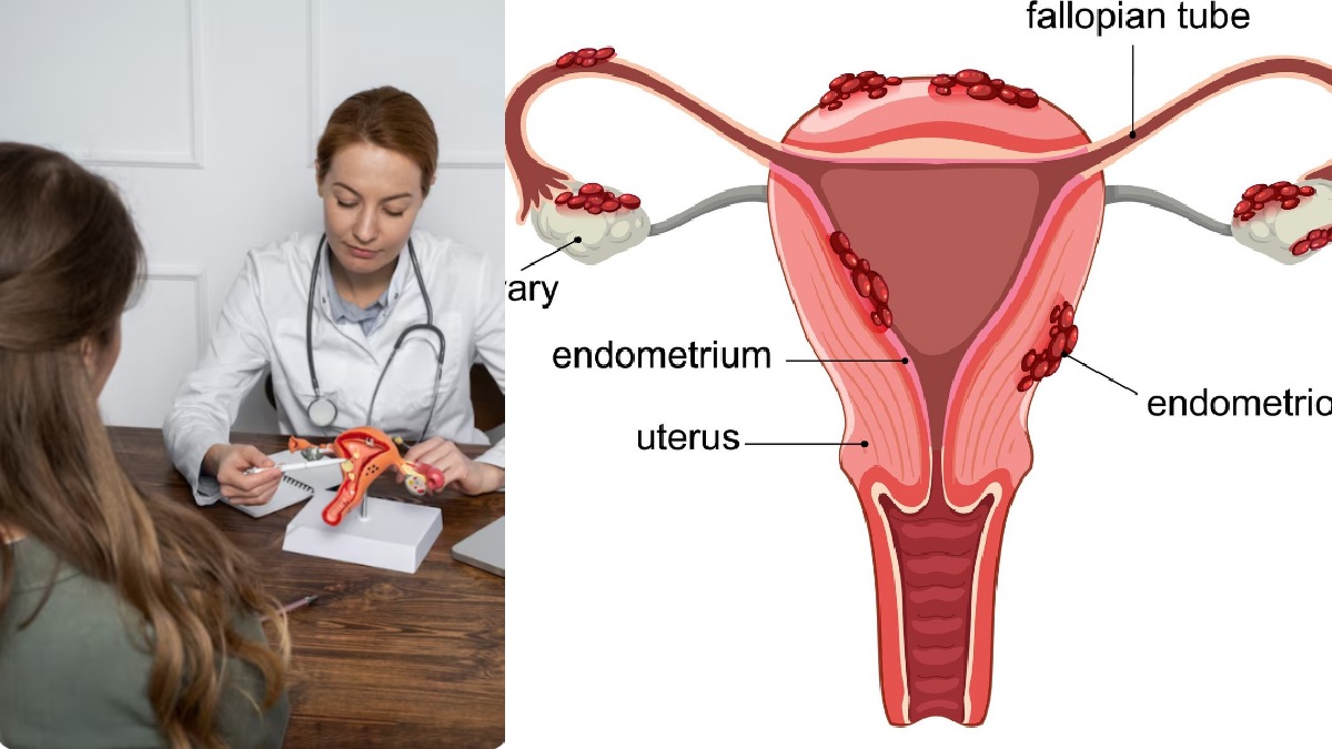PCOS (Polycystic Ovary Syndrome): Symptoms, Causes, Treatment, and Lifestyle Tips for Better Health