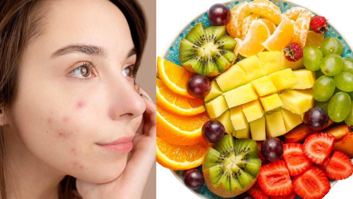 Best Fruit Face Packs for Acne-Prone Skin: Natural Remedies for Clear and Healthy Skin