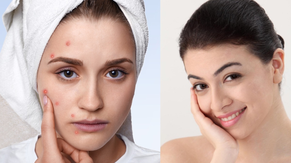 Getting Pimples All Over Your Face This Monsoon? Try These Easy Skincare Tips