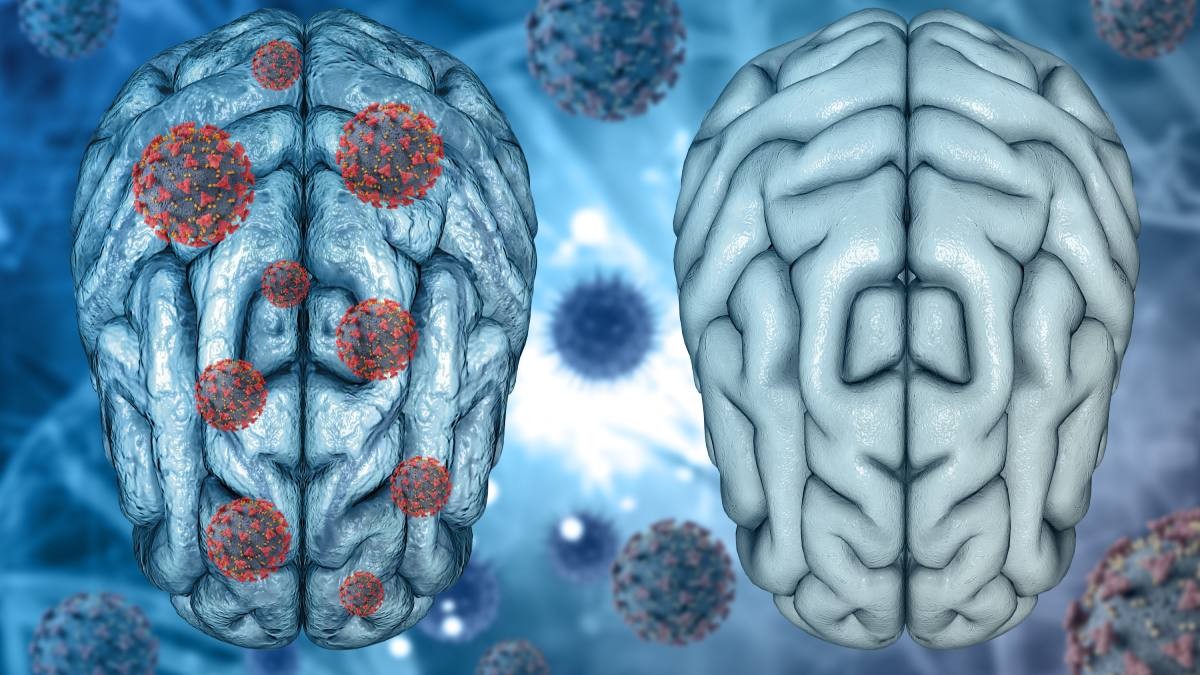 Brain Abscess-Causing Fungus Raises Concern as US Cases Increase: Symptoms and Risks Explained