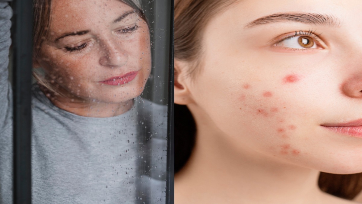 Can Rainwater Harm Your Skin and Cause Acne and Breakouts? What You Need to Know