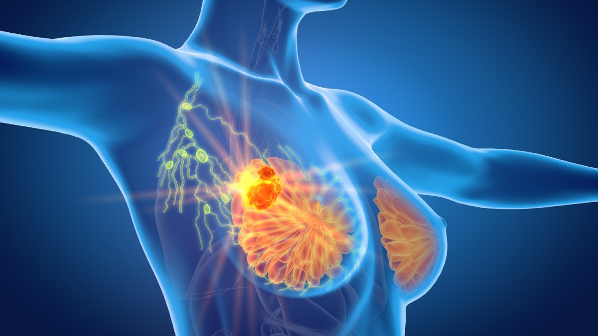 Years of Night Shifts Linked to Higher Breast Cancer Risk: What Women Should Know