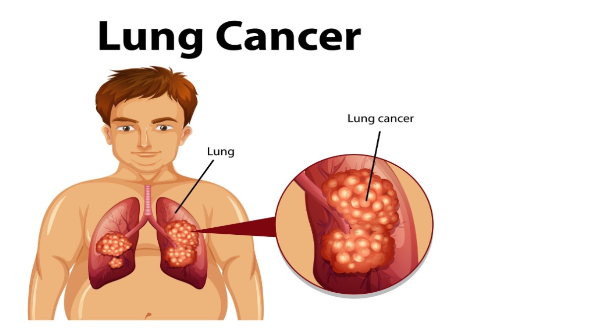 Cough That Lasts More Than Three Weeks: Could It Be Lung Cancer? Warning Signs You Should Never Ignore