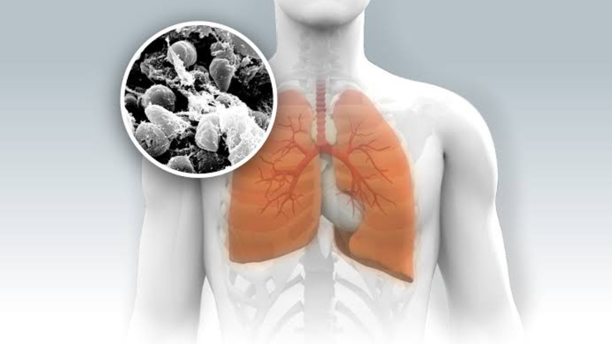 Pneumonic Plague Spreading in Russia