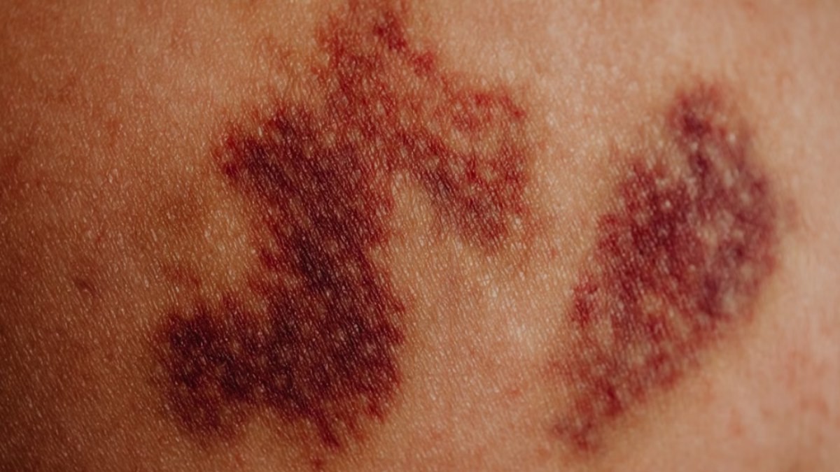 Unexplained Bruising: When Is It Normal And When Should You Worry?